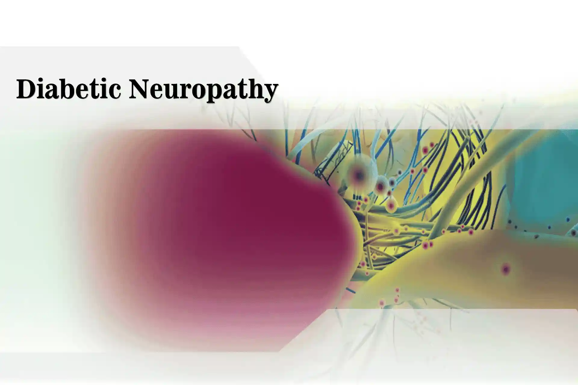 Diabetic Neuropathy